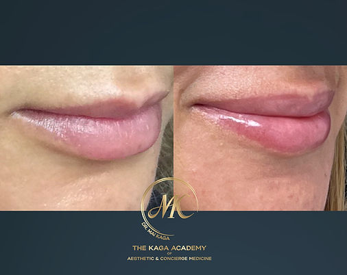 Lip Fillers case #2591