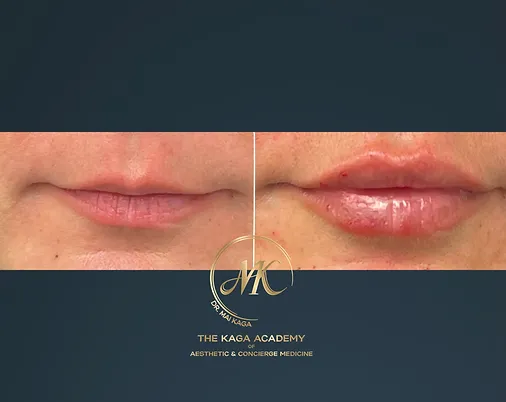 Lip Fillers case #2595