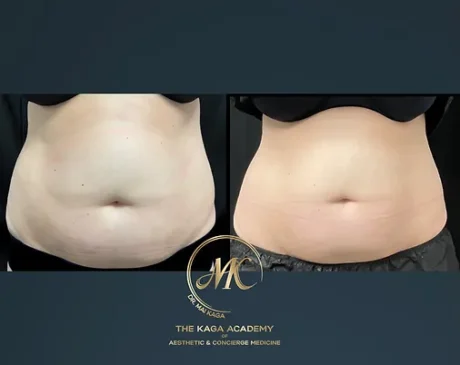 Coolsculpting case #2584