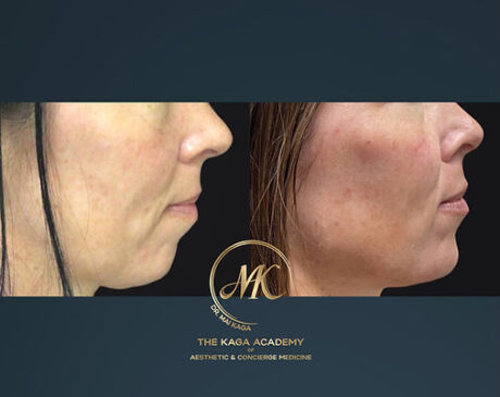 Dermal Fillers case #2589