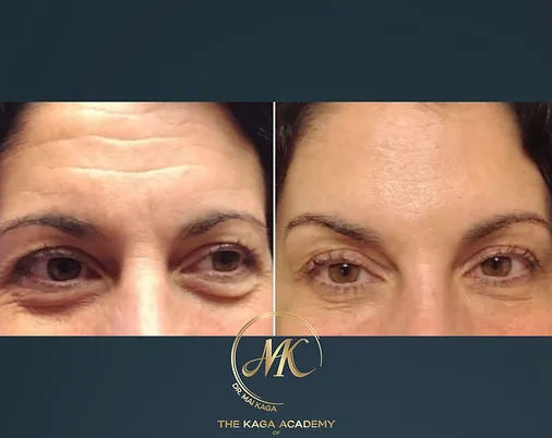 Botox® & Wrinkle Relaxers case #2593