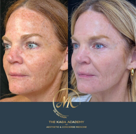 Botox® & Wrinkle Relaxers case #4351