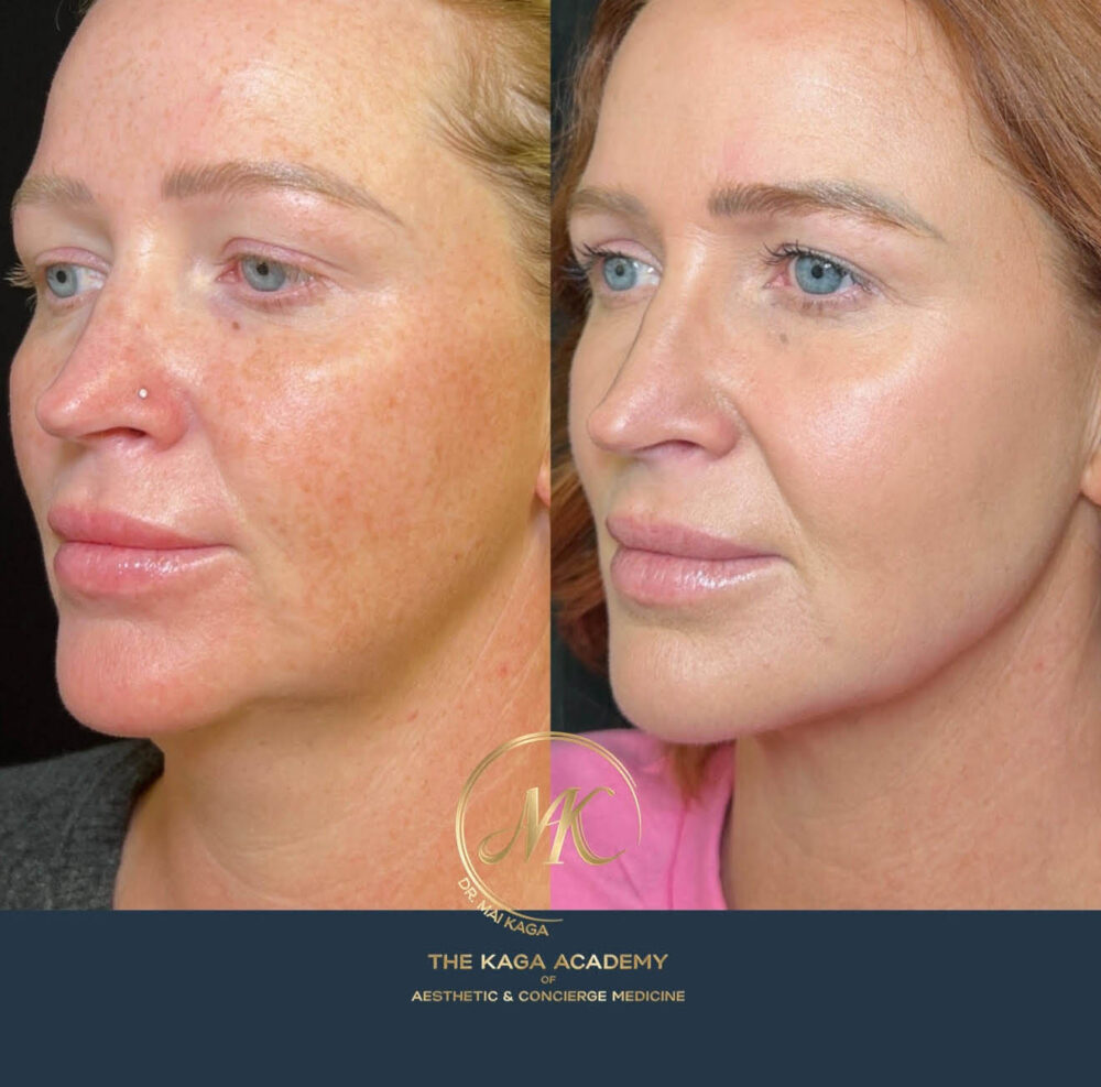 Botox® & Wrinkle Relaxers case #4362