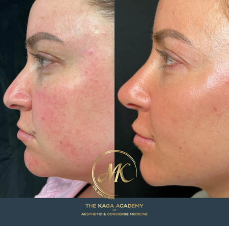 Liquid Rhinoplasty case #4363