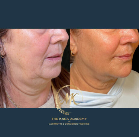 4Point Lift case #4364