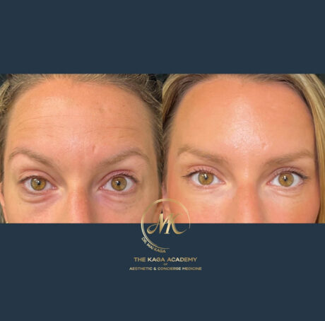 Botox® & Wrinkle Relaxers case #4370