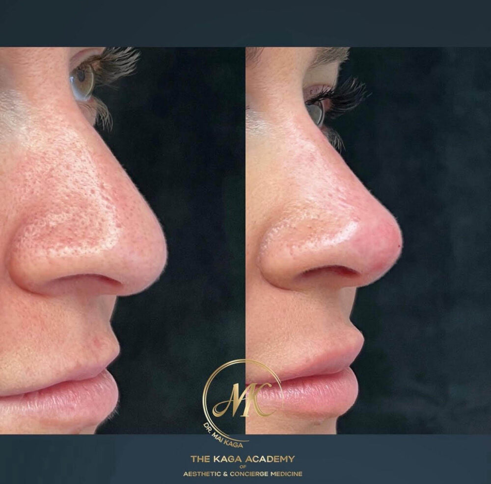 Liquid Rhinoplasty case #4371