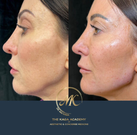 Liquid Rhinoplasty case #4372