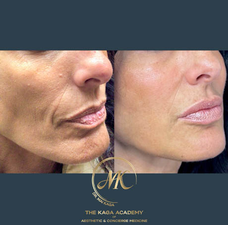 Halo Laser/ Laser Skin Resurfacing case #4834