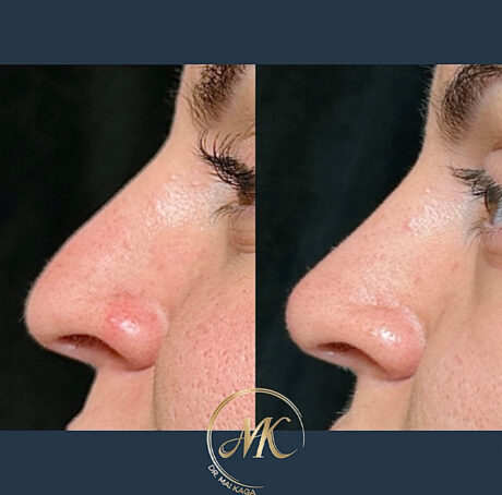 Liquid Rhinoplasty case #4849