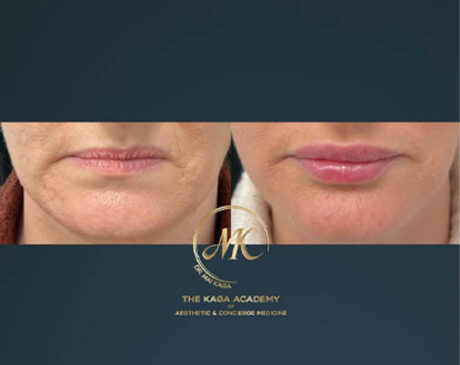 Lip Fillers case #4837