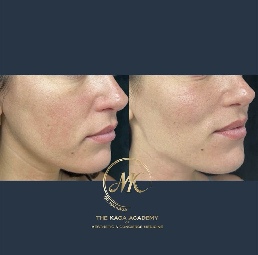 Chin and lip filler