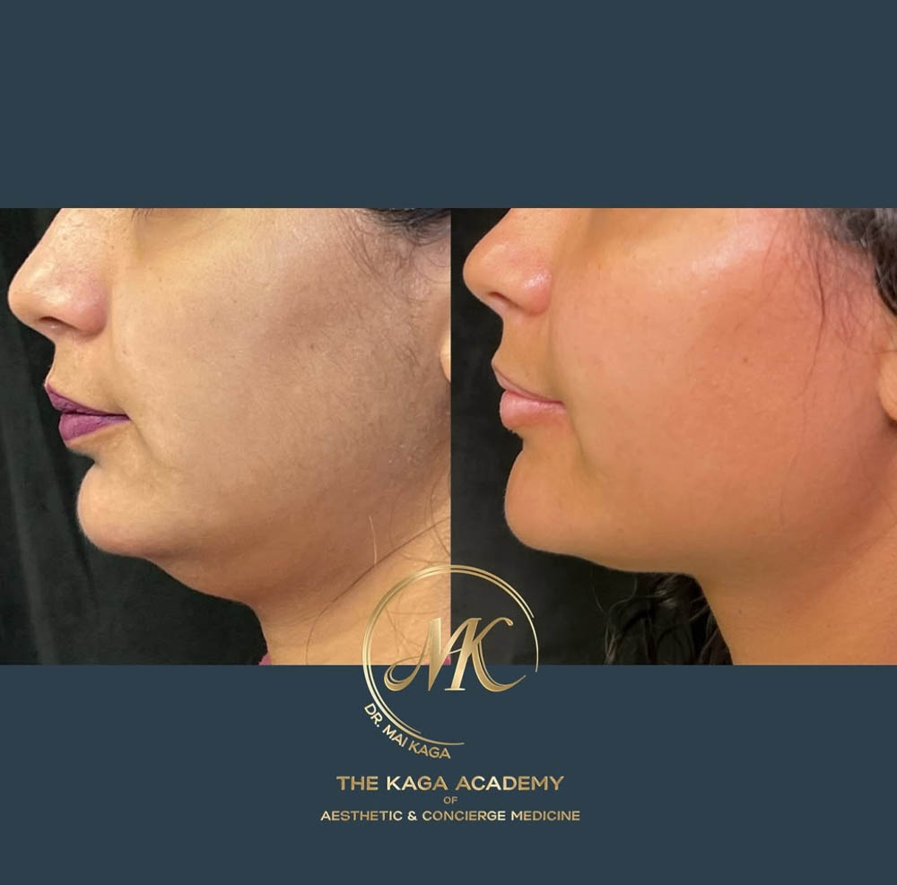 Dermal Fillers case #4599