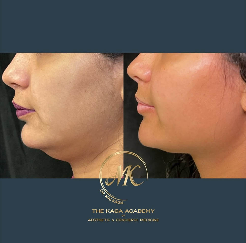 Moxi Laser case #4629