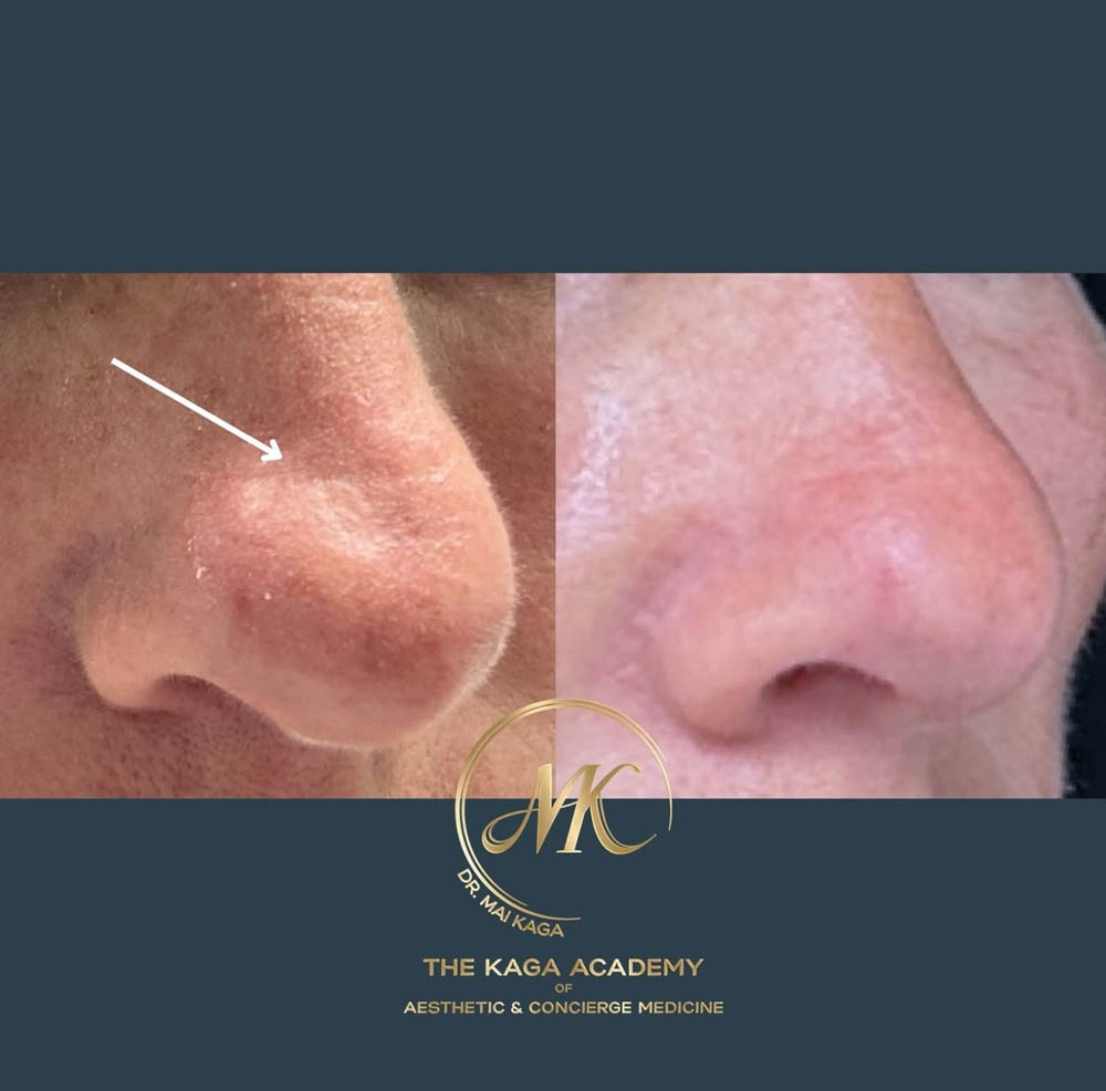 Liquid Rhinoplasty case #4623