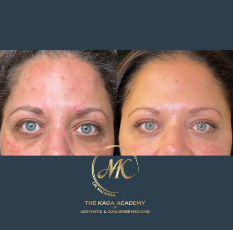 Botox® & Wrinkle Relaxers case #4588