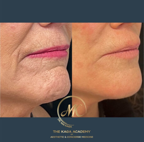Halo Laser/ Laser Skin Resurfacing case #4617
