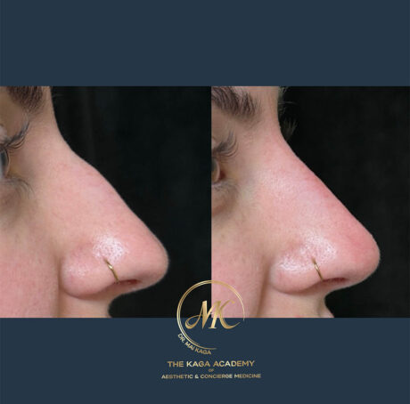 Liquid Rhinoplasty case #4851