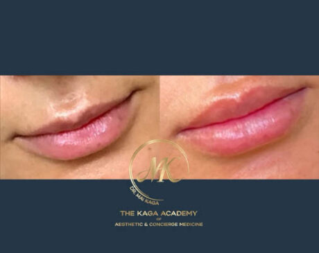 Lip Fillers case #4839