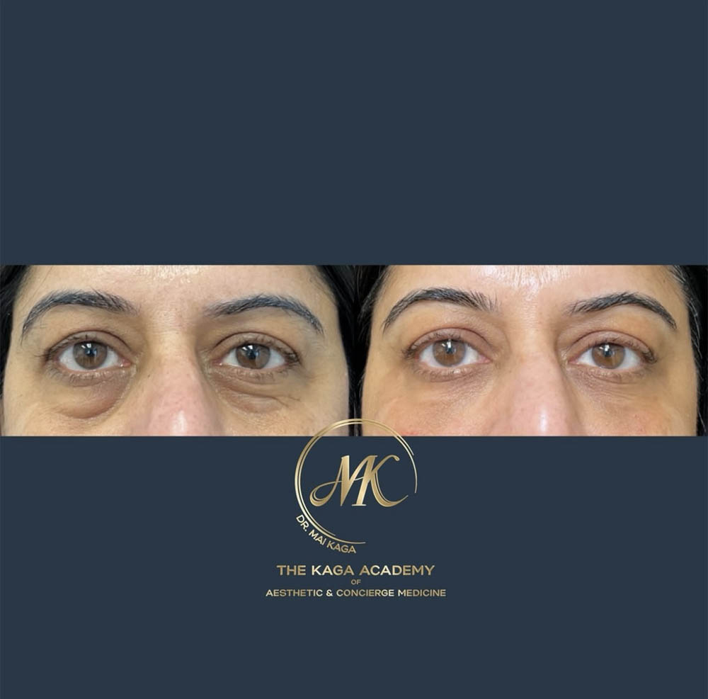 Chin and lip filler