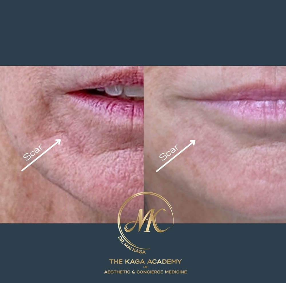Dermal Fillers case #4601
