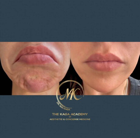 Botox® & Wrinkle Relaxers case #4590