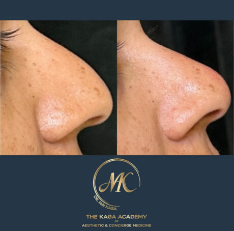 Liquid Rhinoplasty case #4625