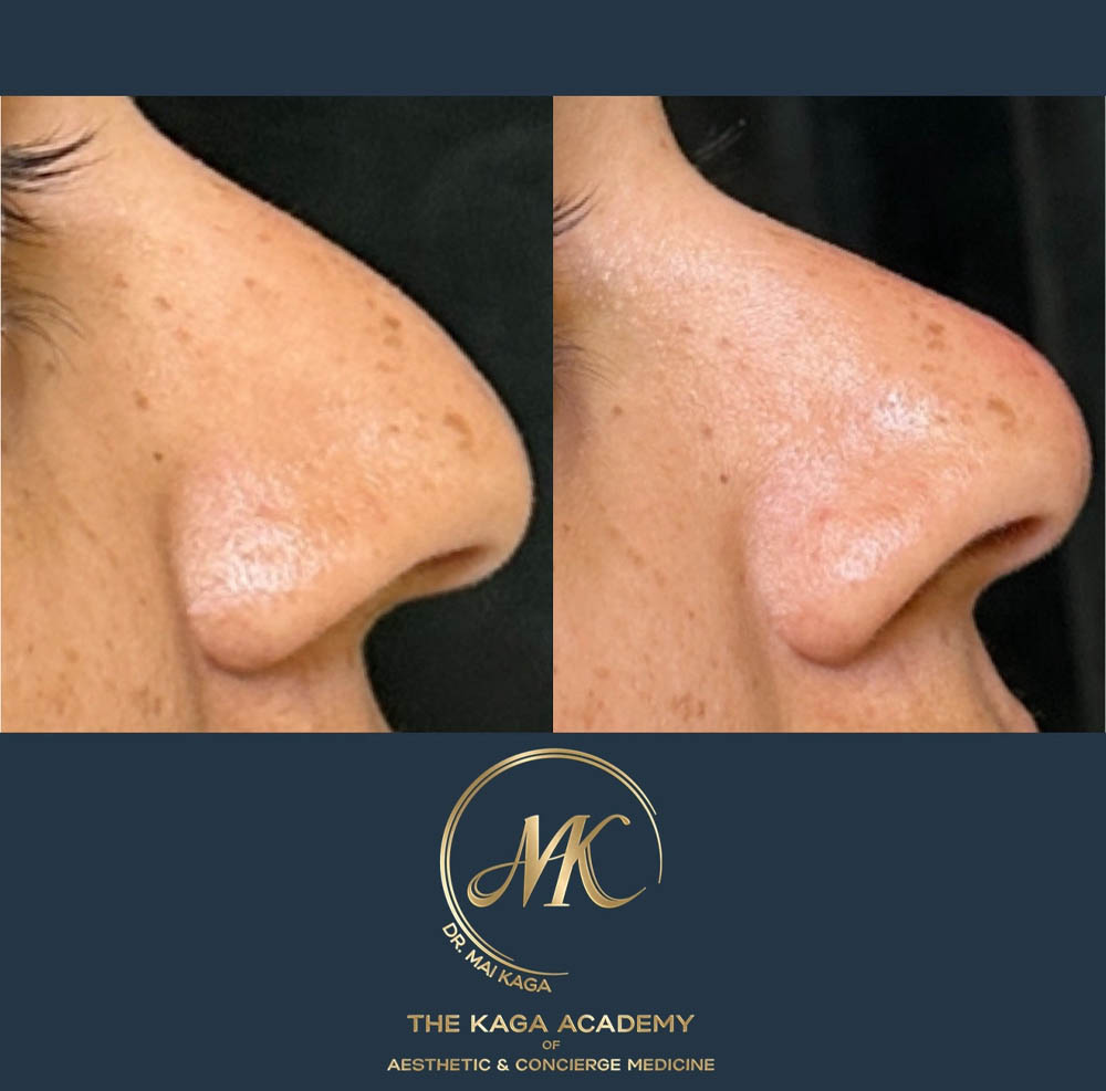 Liquid Rhinoplasty case #4625