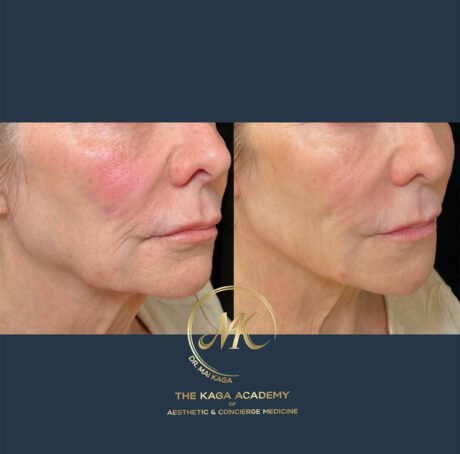 Halo Laser/ Laser Skin Resurfacing case #4619