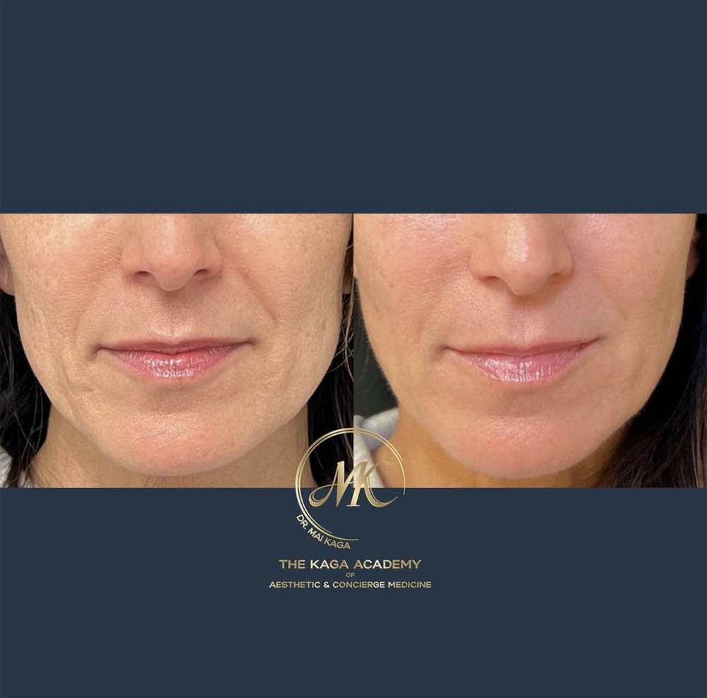 Chin and lip filler