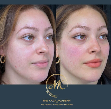 Dermal Fillers case #4603
