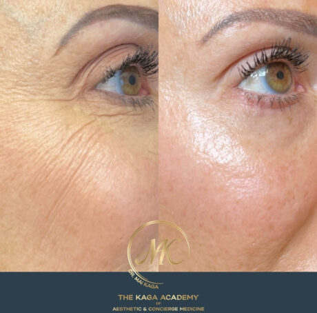 Botox® & Wrinkle Relaxers case #4593