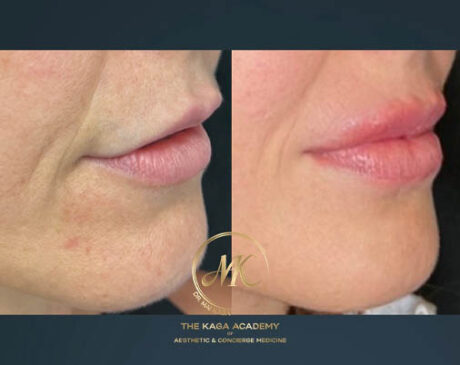 Lip Fillers case #4841