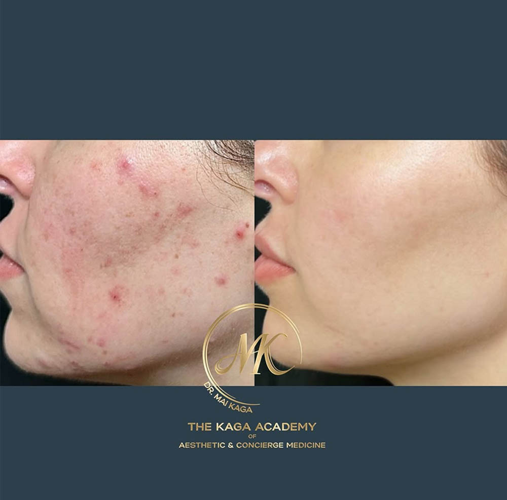 Halo Laser/ Laser Skin Resurfacing case #4621