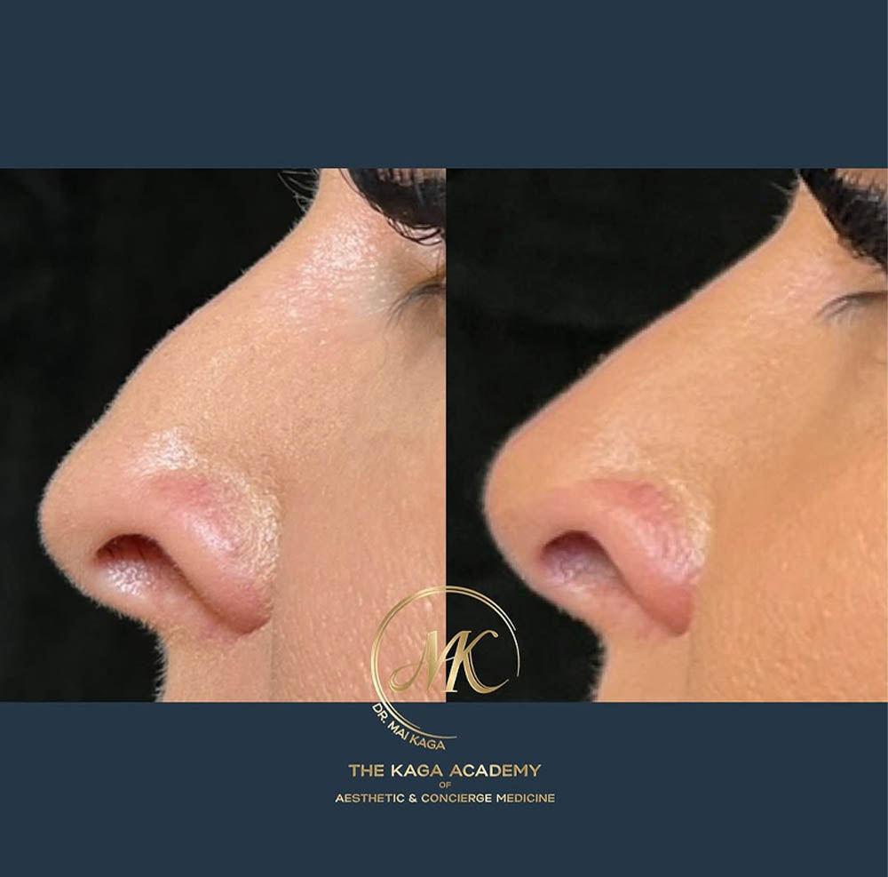 Liquid Rhinoplasty case #4627