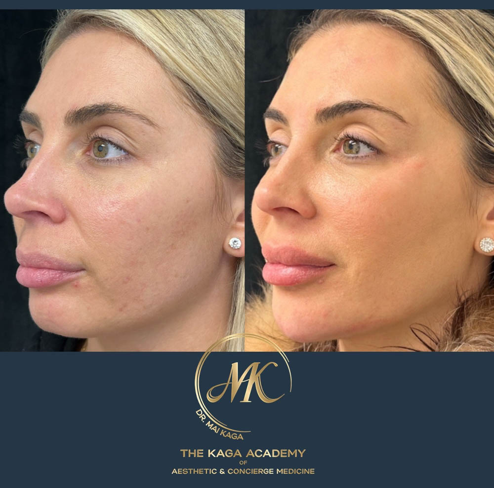 Dermal Fillers case #4605