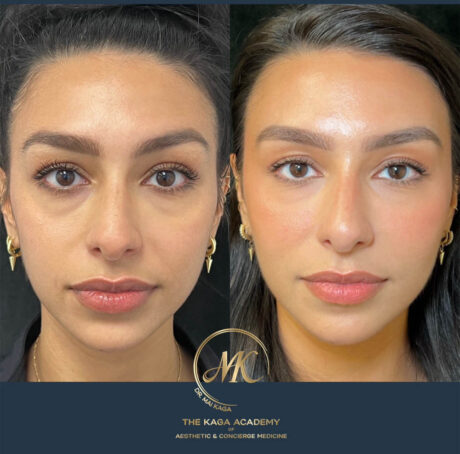Dermal Fillers case #4830