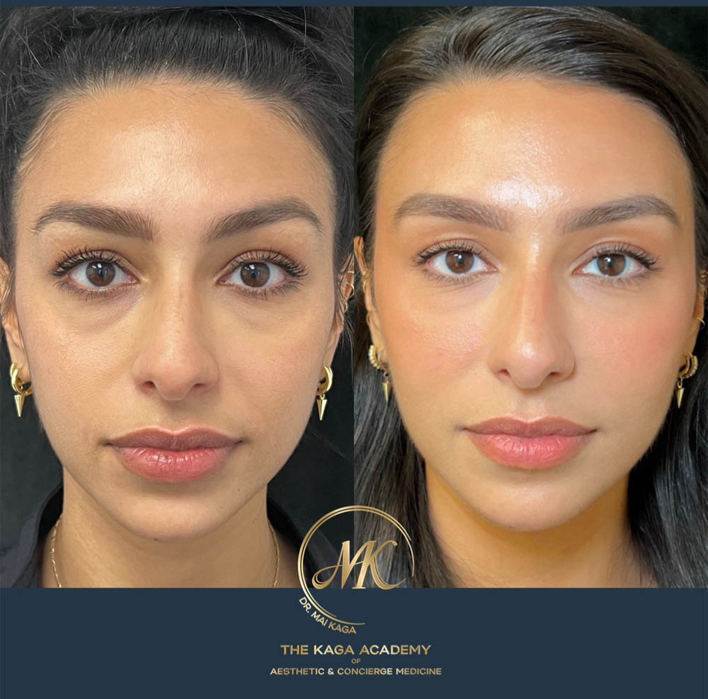 Dermal Fillers case #4830