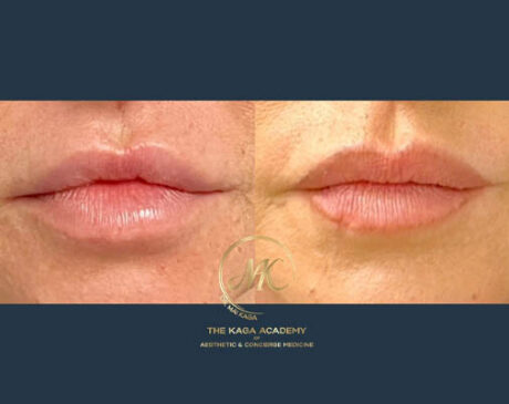 Lip Fillers case #4843