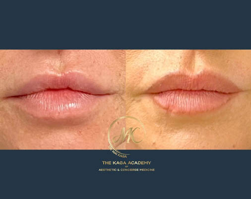 Lip Fillers case #4843