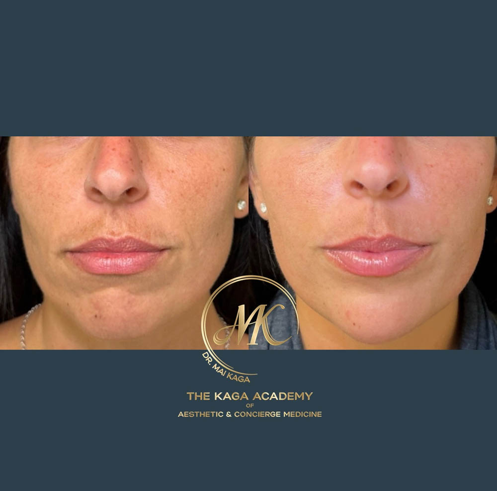 Dermal Fillers case #4607