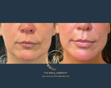 Lip Fillers case #4845