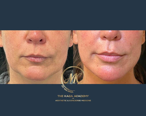 Lip Fillers case #4845