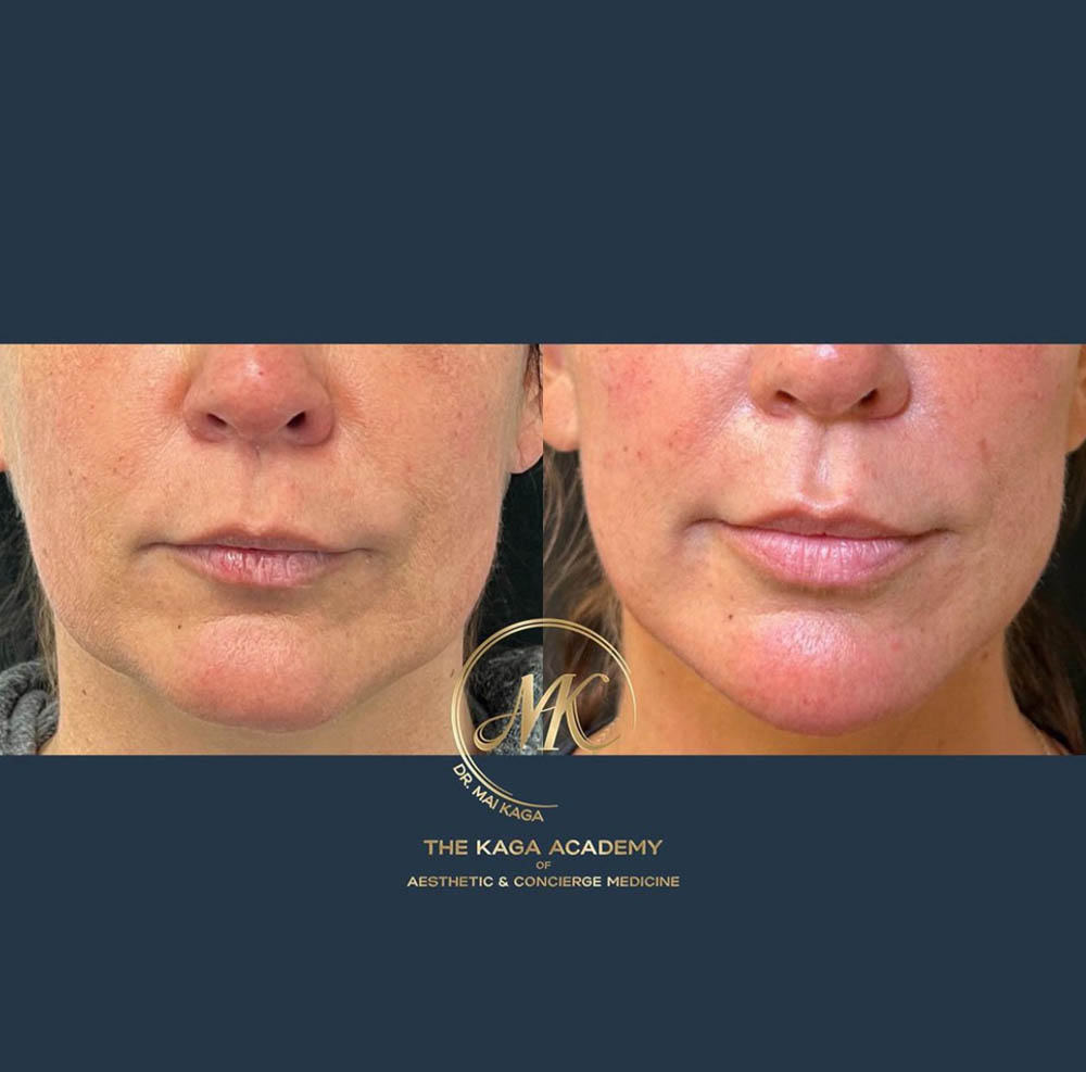 Dermal Fillers case #4832