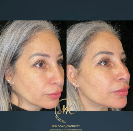 Dermal Fillers case #4609
