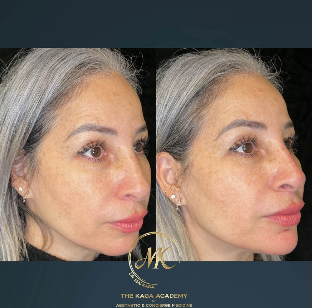 Dermal Fillers case #4609