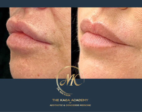 Lip Fillers case #4847
