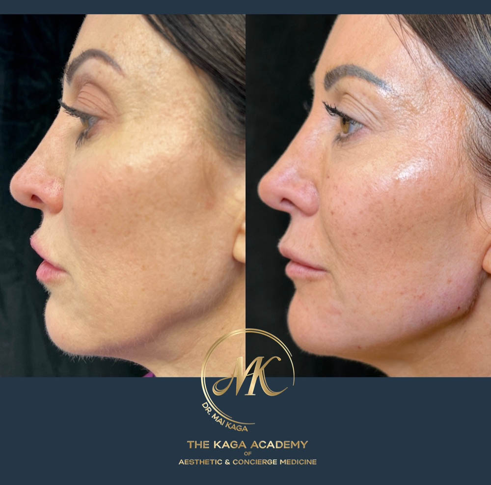 Dermal Fillers case #4611