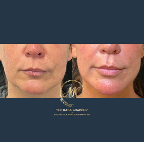 Dermal Fillers case #4613