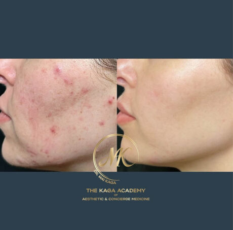 Dermal Fillers case #4615
